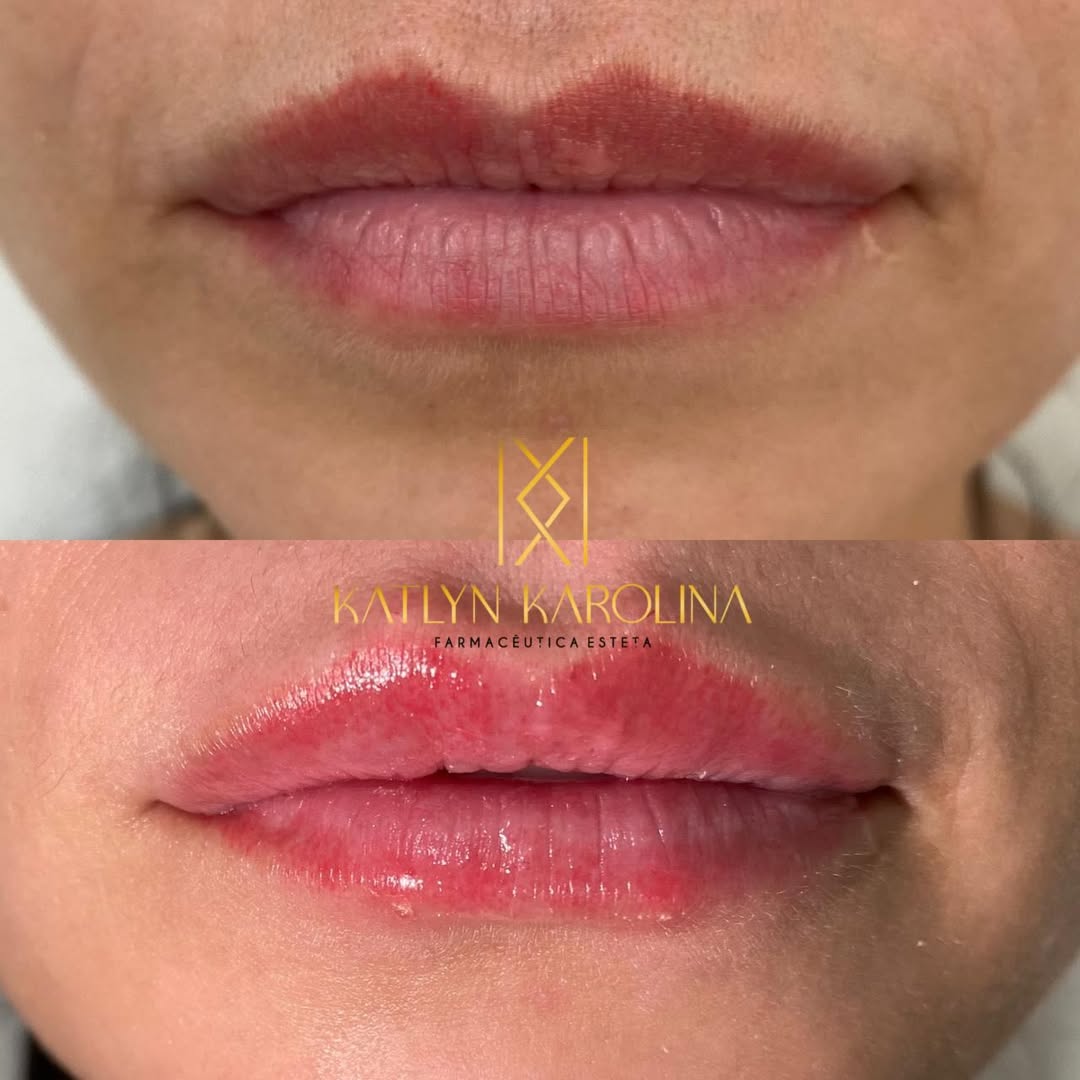 Resultado de preenchimento labial